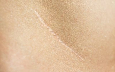 Scar-Free Healing? A Parasitic Worm Could Be the Key