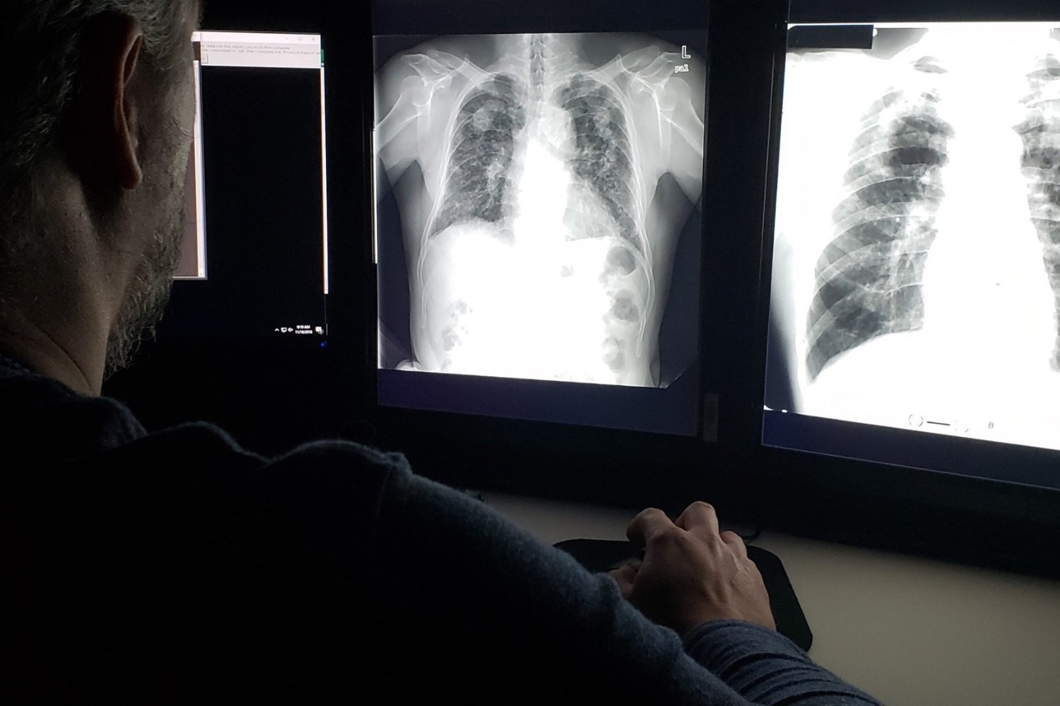 Lung Power Peaks in 20s: A Steady Decline Follows