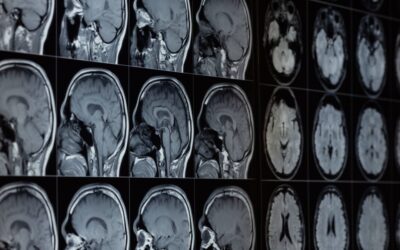 Lithium Loss in Our Brains Could Fuel Alzheimer’s, Study Reveals