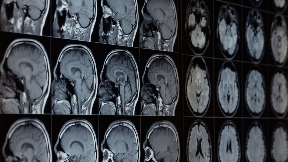 Lithium Loss in Our Brains Could Fuel Alzheimer’s, Study Reveals
