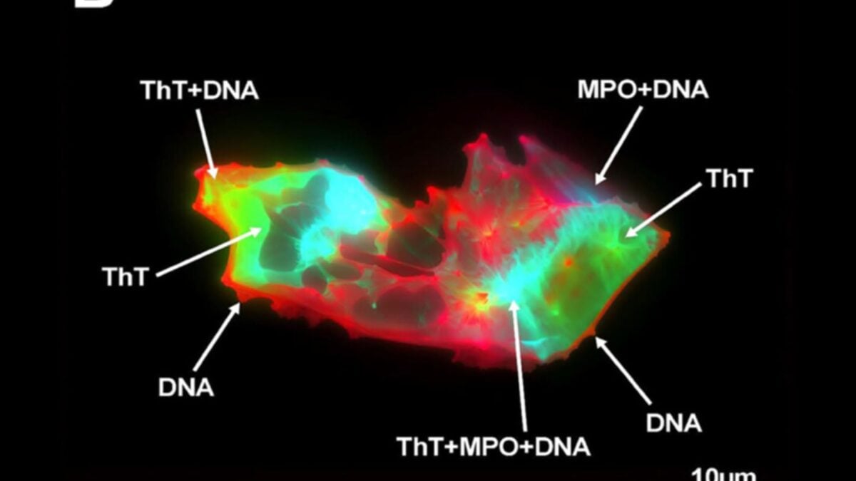 Long Covid Reveals Unusual Blood Condition in Patients